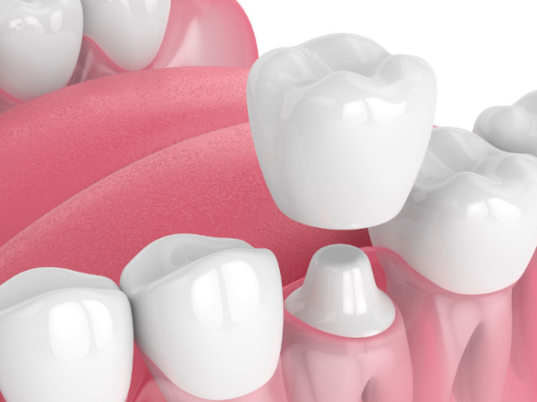 A crown being inserted onto a tooth